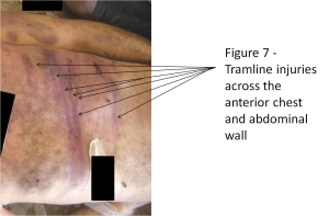 Tramline bruises are produced by blows with rod-like objects, the report explains. ©Carter-Ruck and Co.